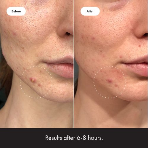 Mighty Patch™ Invisible+ Acne Pimple Patches - Ultra Thin Hydrocolloid Stickers for Face (24 Medium, 15 Small)