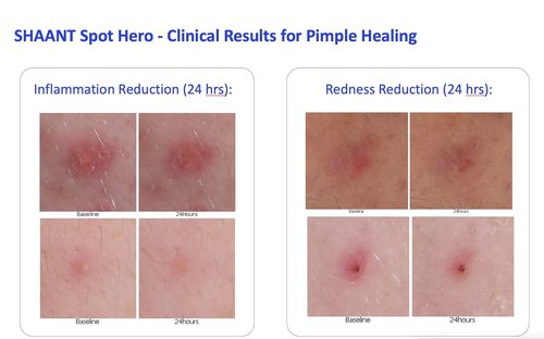 Codex Labs Shaant Spot Hero - 5% Sulfur Acne Treatment | Clinically Tested Formula for Sensitive Skin | 0.5 oz