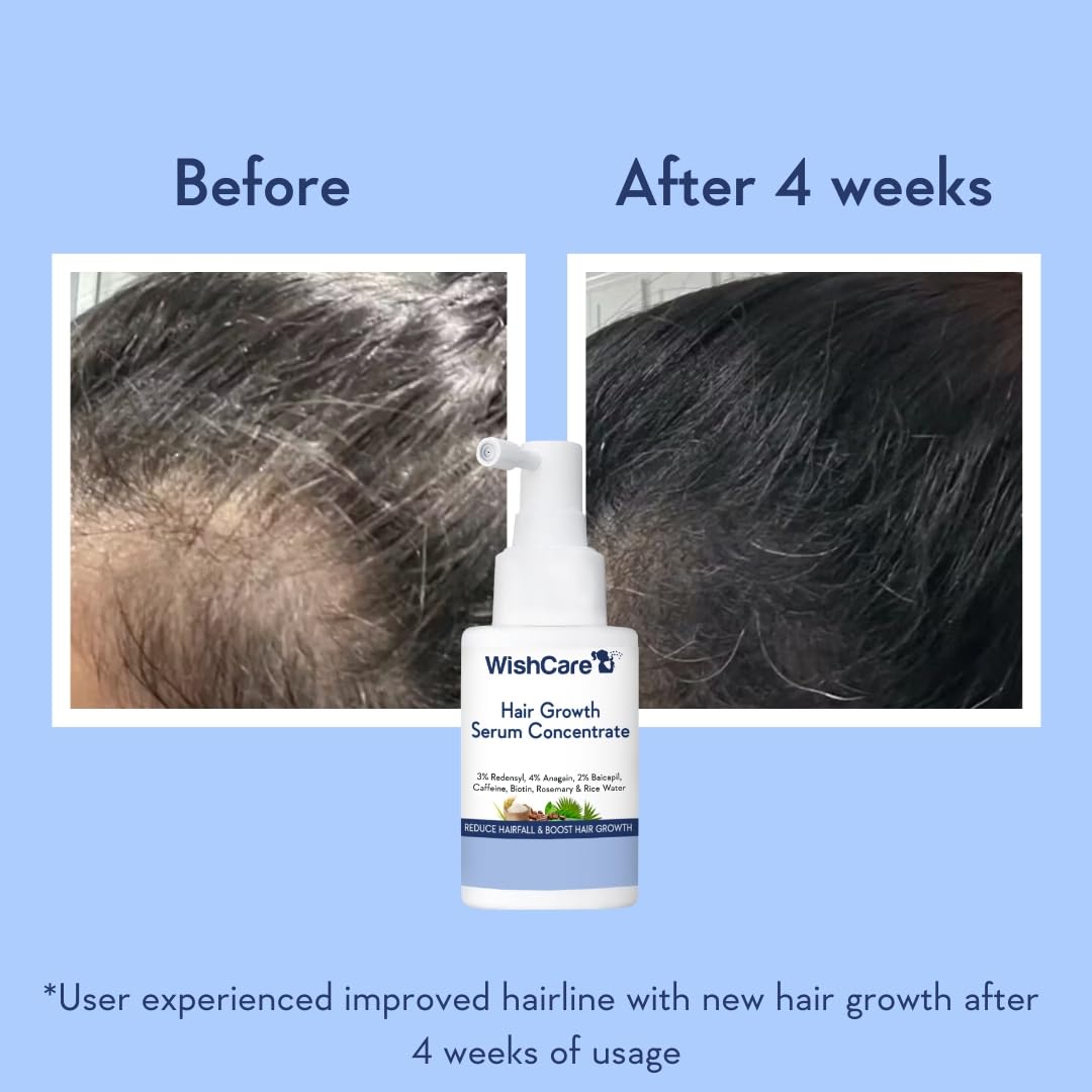WishCare Hair Growth Serum - Concentrated Formula with Rosemary, Redensyl, Biotin & Caffeine, 1.7 oz