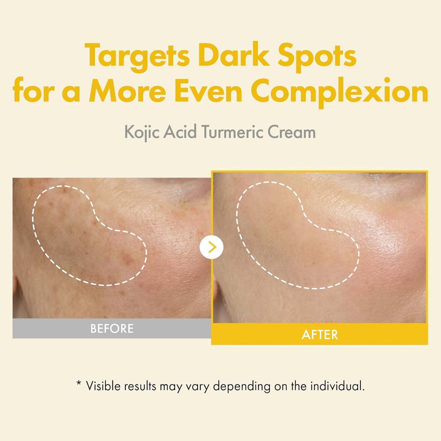 TOSOWOONG Kojic Acid Turmeric Cream - Dark Spot Corrector for Even Skin Tone | 50ml / 1.69 fl. oz.