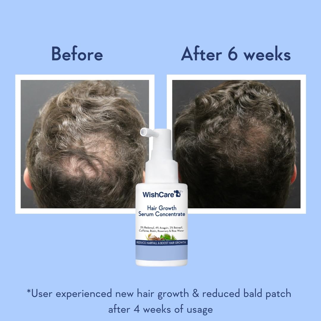 WishCare Hair Growth Serum - Concentrated Formula with Rosemary, Redensyl, Biotin & Caffeine, 1.7 oz