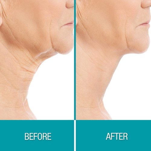 Dermactin-TS Collagen Chin Mask - Skin Firming Treatment in .35 Ounce Packette