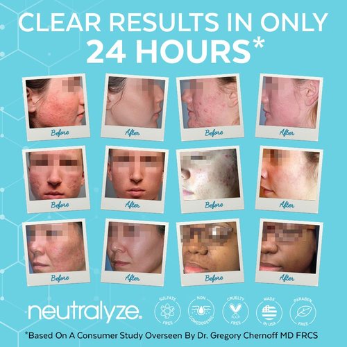 Neutralyze Acne Treatment Kit 2.0 - Maximum Strength 3-Step System with 2% Salicylic Acid & Mandelic Acid | Includes Face Wash, Clearing Serum & Synergyzer