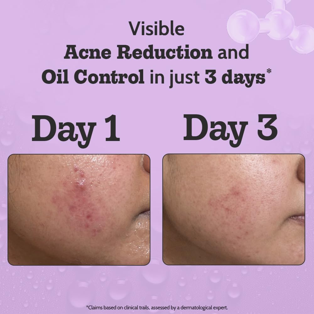 Chemist At Play 2% Salicylic Acid Face Serum - Treats Acne & Controls Oil | Fades Marks | 30ml