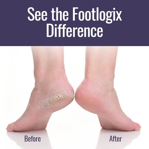 Footlogix Callus Softener Combo - Callus Remover Spray & Double-Sided Foot File for Dry, Cracked Heels