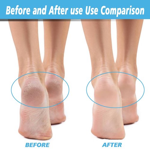 6 Pack Replacement Roller for Flawless Pedi, Replacement Head Refills Compatible with Finish Touch Flawless Pedi Electronic Tool File,3 Extra Coarse & 3 Regular Coarse