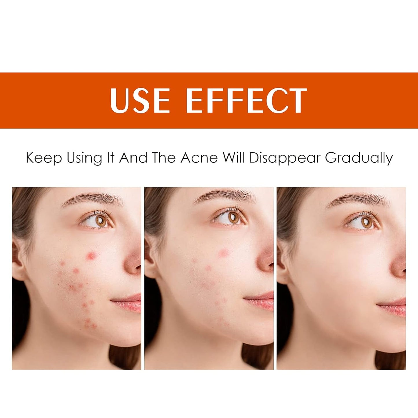 Skiennix Acne Treatment Cream - Rapid Clearing for Hormonal & Cystic Acne | 30g Blemish Spot Treatment