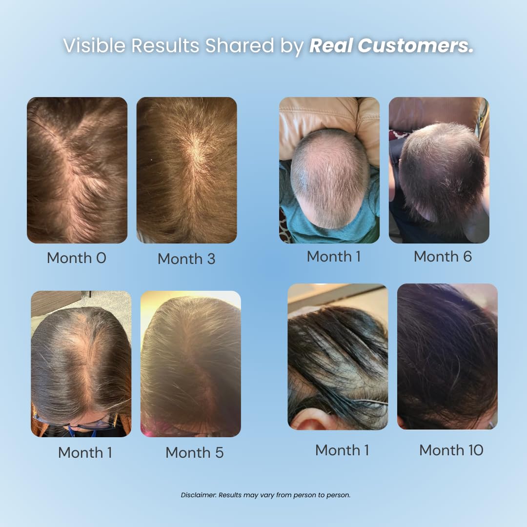Vitafoam 5% Minoxidil Foam - DHT Blocking Formula for Men & Women | Non-Greasy, Fast-Drying Hair Regrowth