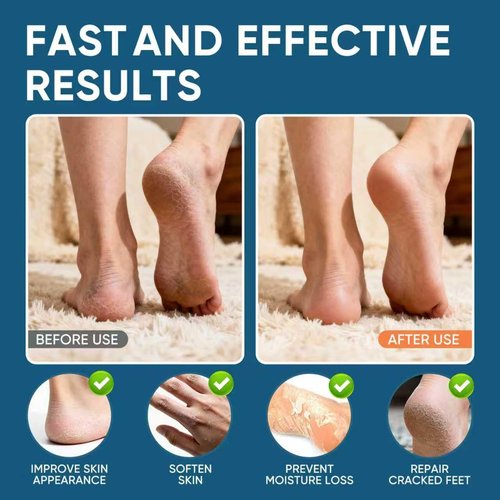Regine Switzerland Urea Cream 60% with Salicylic Acid - Maximum Strength Foot Cream for Dry, Cracked Heels