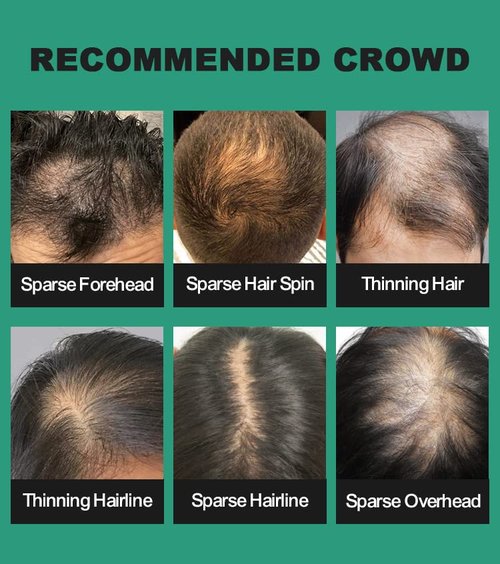 Hair Building Fibers for Thinning Hair for Men & Women 27.5g Bottle with Applicator | Fill In Thinning and Fine Hair for an Instantly Fuller, Thicker Look | Keratin Hair Fibres [BLACK Hair Fiber]
