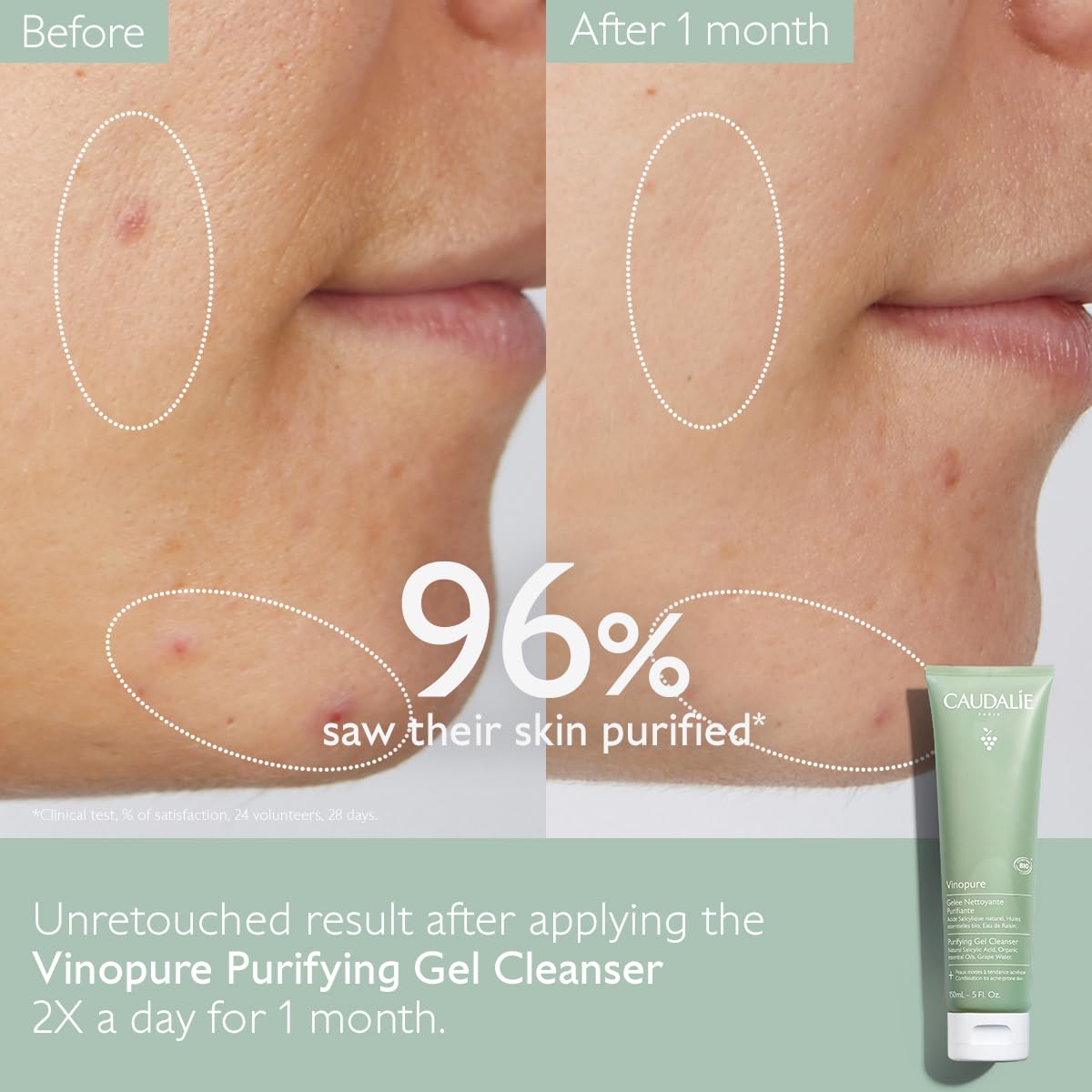 Caudalie Vinopure Salicylic Acid Cleanser - Pore Purifying Gel, 150 mL (Pack of 2)