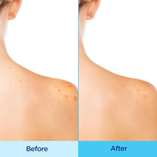 Differin Acne Body Spray - Salicylic Acid Treatment for Back, Chest & Shoulders | 6 oz
