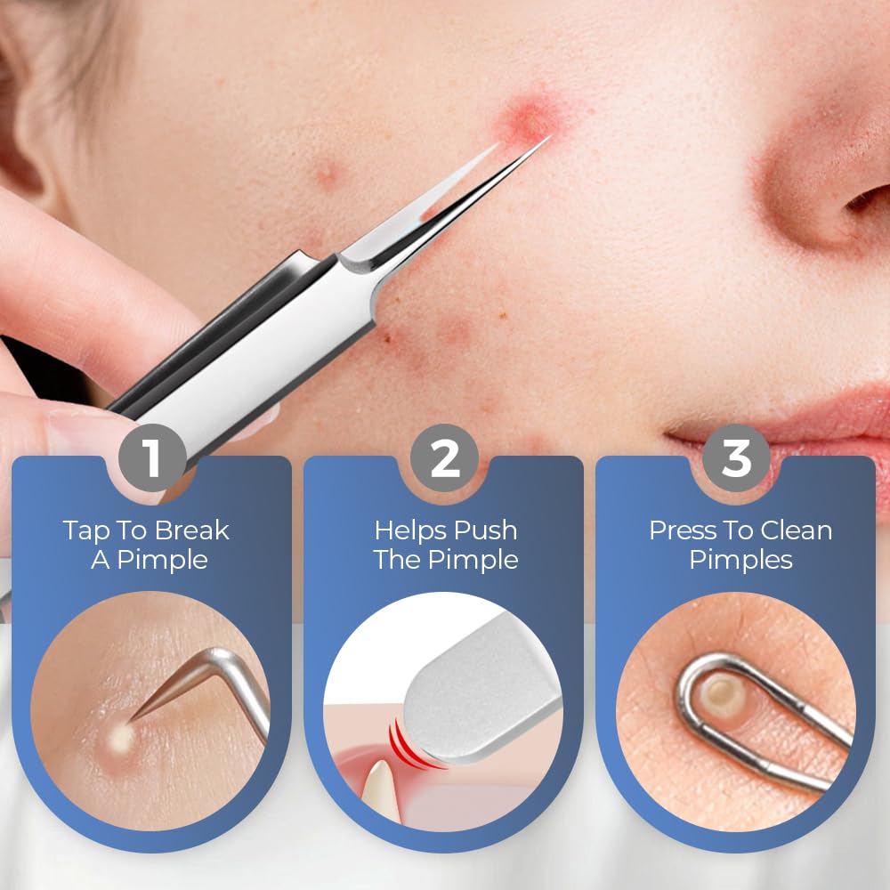 Medical Grade Stainless Steel Blackhead Remover Tools Extraction Kit, Professional Blackhead/Whiteheads/Milia/Pimples Remover for Face (9PCS with 15x Magnifier)