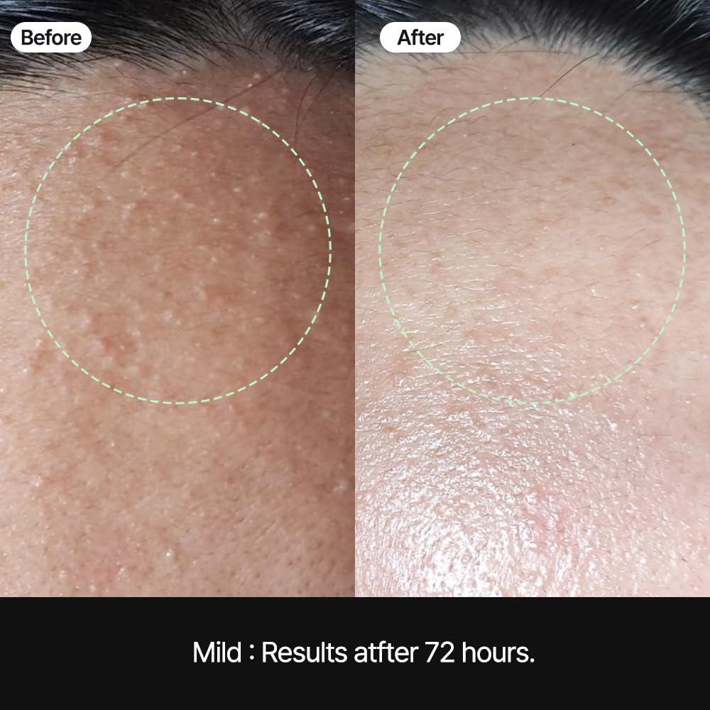 Comedones Soonsak Patch Booster (50 sheets) - The most powerful acne patch that melts and removes hard sebum with our own technology