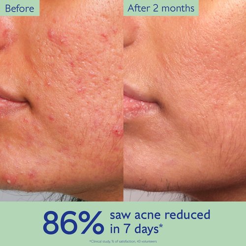 Caudalie Vinopure Acne Serum - Treat & Prevent Blemishes | Includes 2 Free Travel-Size Products