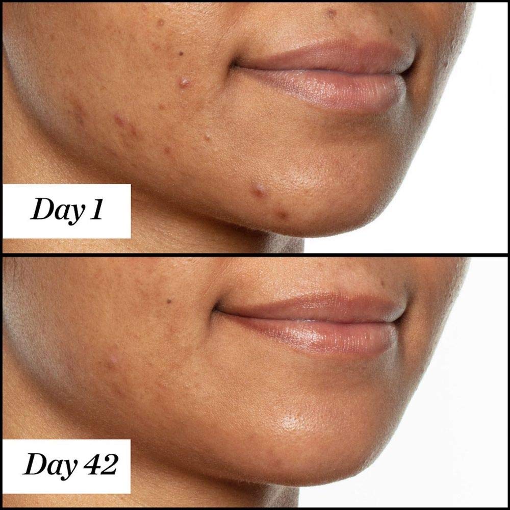 Sunday Riley U.F.O. Acne Treatment Face Oil - Ultra-Clarifying Salicylic Acid & Tea Tree Oil