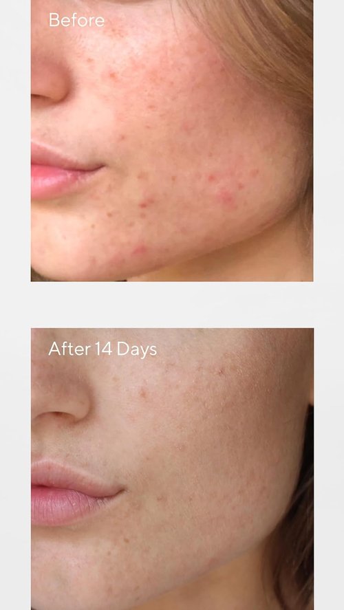 Murad Women's Invisiscar Resurfacing Treatment