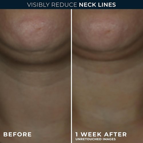 RoC Derm Correxion Neck Cream - Hyaluronic Acid & Retinol for Tightening & Lifting (1.7 oz) | Includes Eye Packette