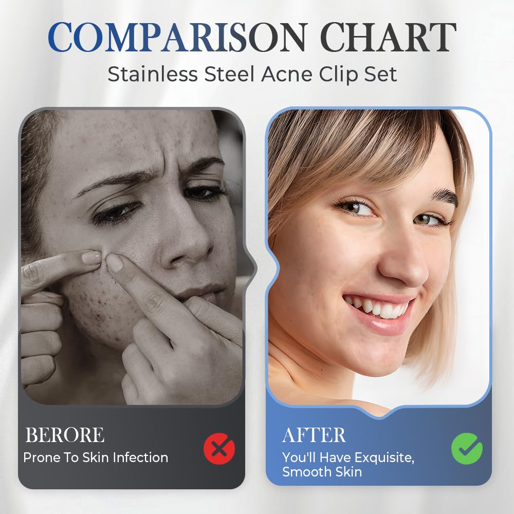 Medical Grade Stainless Steel Blackhead Remover Tools Extraction Kit, Professional Blackhead/Whiteheads/Milia/Pimples Remover for Face (9PCS with 15x Magnifier)