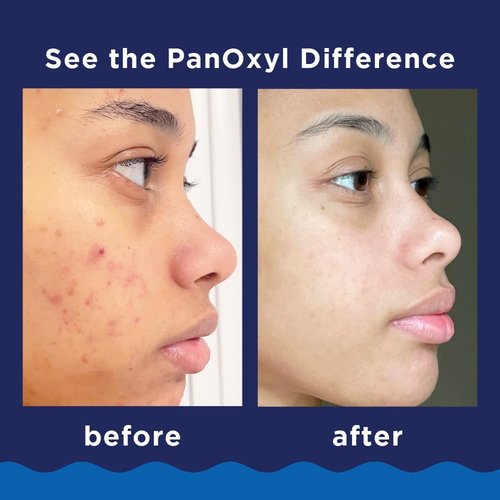 PanOxyl Acne Foaming Wash & PM Overnight Spot Patches - 10% Benzoyl Peroxide Duo Bundle