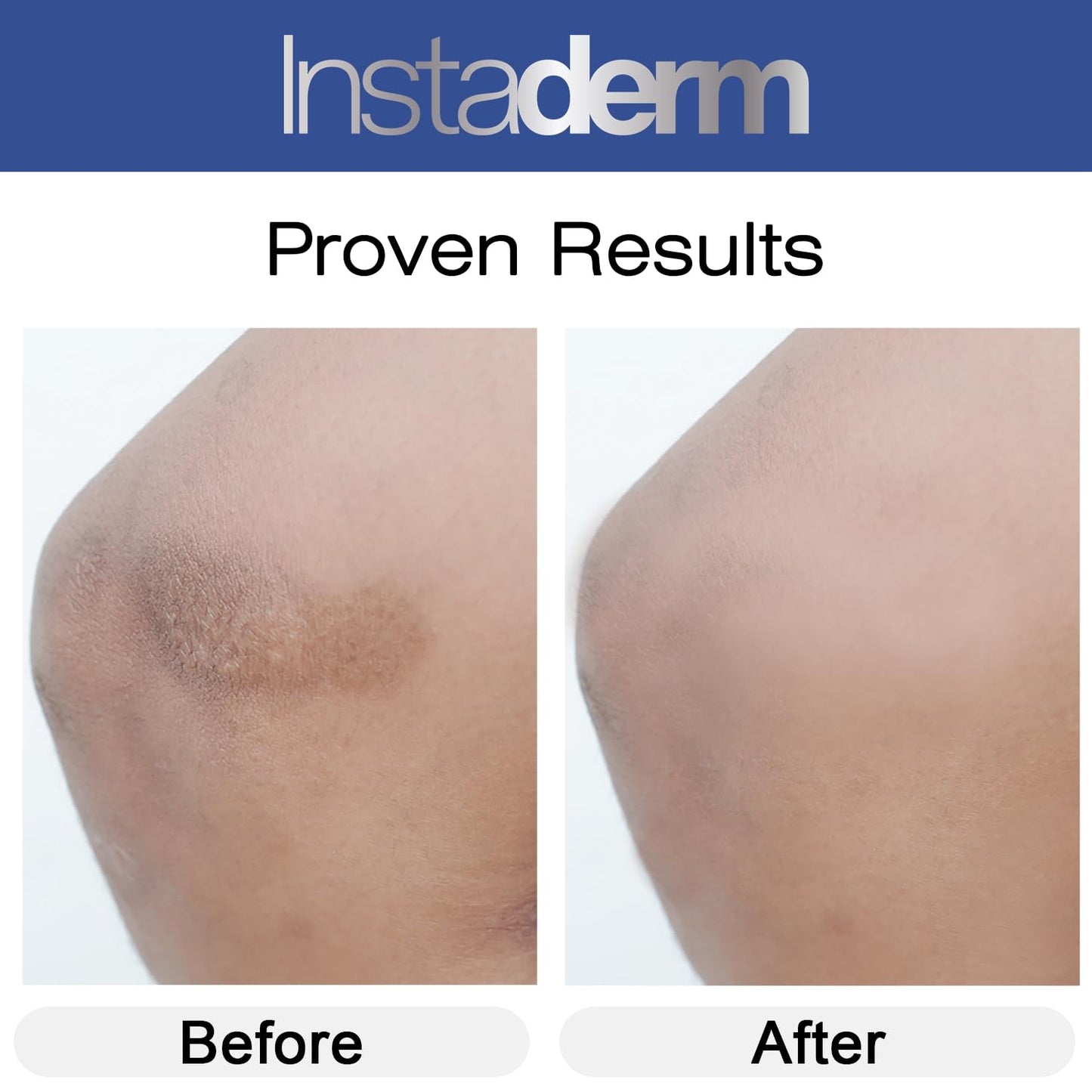 Instaderm Vitamin K Cream- Bruise Healing Formula with Arnica. Dark Spot Moisturizer for Bruising, Spider Veins & Broken Capillaries. Repair Under Eye Dark Circles, & Puffiness.