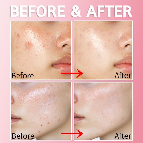 Purederm Blemish Spot Treatment Gel - Salicylic Acid 2% for Soothing Acne Care, 20ml