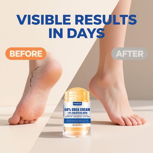 ZyraGloz Urea Cream Stick 60% plus Salicylic Acid 2%, Maximum Strength Urea Foot Cream for Dry Cracked Heels, Feet Callus Remover, Hands Knees Exfoliating Dead Skin, Softening Skin Moisturizer Lotion
