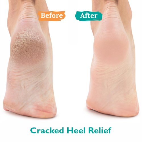 Gilden Tree Urea Gel 42% - Maximum Strength Treatment for Cracked Heels & Thick Toenails
