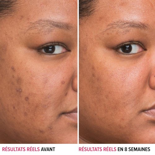 IT Cosmetics Bye Bye Dark Spots Serum - 4% Niacinamide for Dark Spot Reduction & Skin Clarity - 1 Fl. Oz