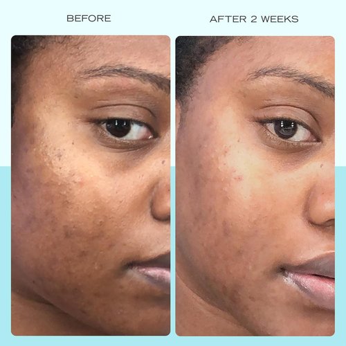 First Aid Beauty - Dark Spot Serum with Niacinamide | Reduces Dark Spots & Hyperpigmentation, 1 oz