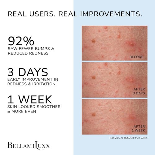BellamiLuxx Folliculitis Acne Lotion - Reduces Itch, Redness & Body Acne with Salicylic Acid | Gentle Care for Sensitive Skin