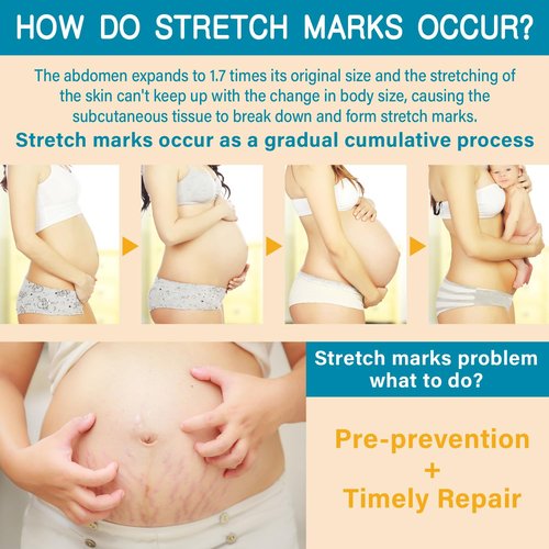 PEGO Stretch Mark Butter - Maternity Cream for Reducing Scars & Moisturizing Skin | 100g/3.53oz