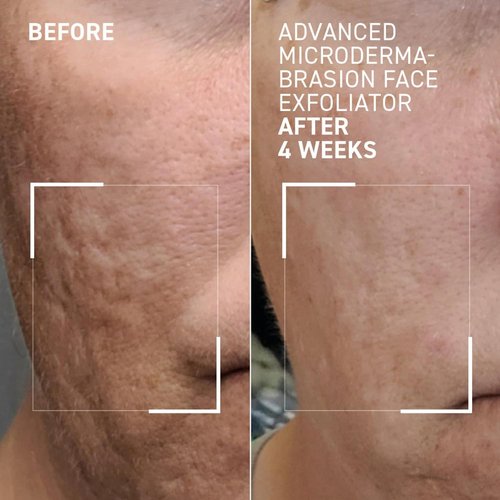 Dr. Brandt Advanced Microdermabrasion Face Exfoliator - Refines Texture & Minimizes Fine Lines - 2 oz