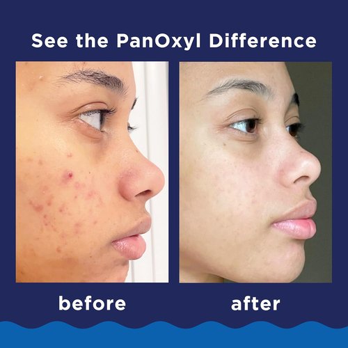 PanOxyl Acne Foaming Wash - Maximum Strength 10% Benzoyl Peroxide, Antimicrobial Formula | 3 Oz, Pack of 2