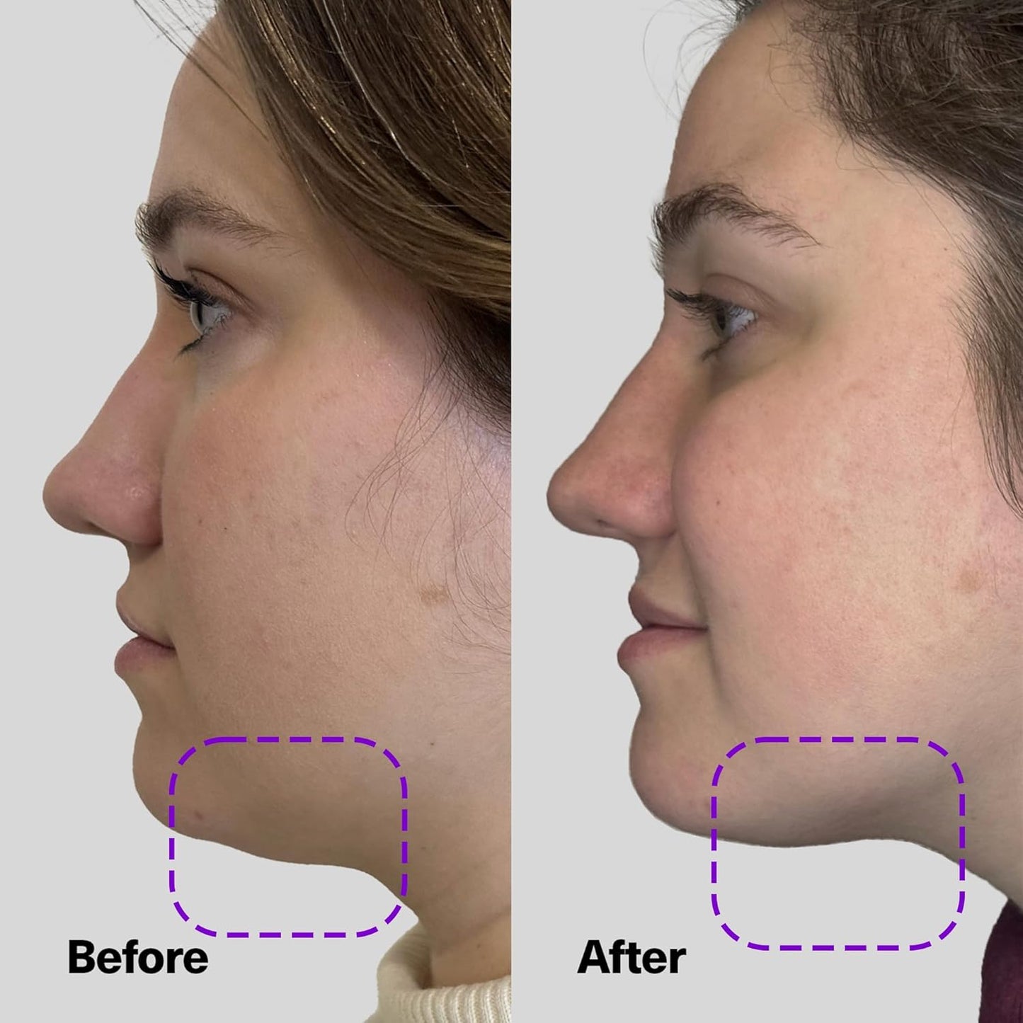 SickScience ShapeShift Advanced Jaw & Neck Firming Serum - Double Chin Reducer & Face Tightening Treatment with Exosome Technology, 1.7oz