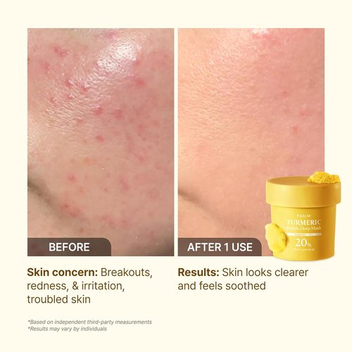 P.CALM Turmeric Bubble Deep Mask - Dark Spot Corrector with AHA/BHA & Carbonated Water | Korean Skincare, 90g