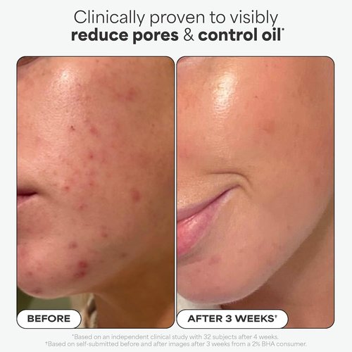 Paula's Choice SKIN PERFECTING 2% BHA Liquid Exfoliant - Salicylic Acid Facial Polish for Enlarged Pores & Fine Lines | Fragrance-Free, Ideal for Blackhead-Prone Skin