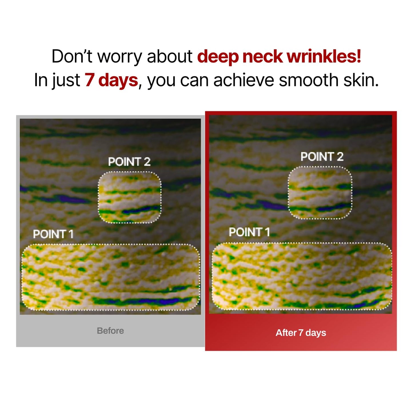 Wrinkle-fit Neck Mask 7EA + Boosting Roller - Neck Wrinkle Patches, Firming and Tightening Korean Deep Collagen Mask - NeckTargeted Mesh Sheet Mask and Face Roller for Lifting Sagging Skin