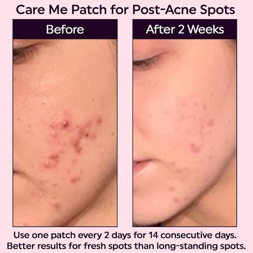 Care Me Microdart Dark Spot Patch - 127 Micropoints for Fading Acne Marks & Dark Spots | 1 Pack of 9 Patches