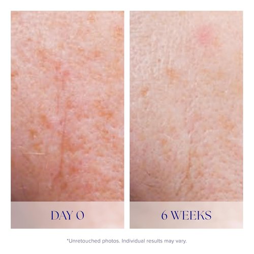 iS CLINICAL Active Serum - Even Skin Tone & Anti-Aging Benefits | Ideal for Acne-Prone Skin
