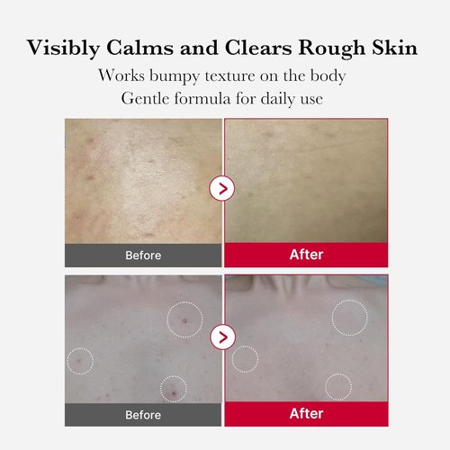 Medicube Red Body Peeling Shot - AHA + BHA Exfoliating Body Spray for Smooth Skin | 3.88 oz