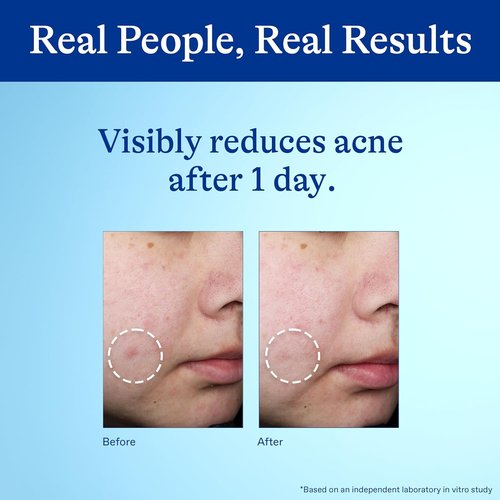 Differin Acne Spot Treatment - Maximum Strength 10% Benzoyl Peroxide | Fast-Acting 1 oz Solution
