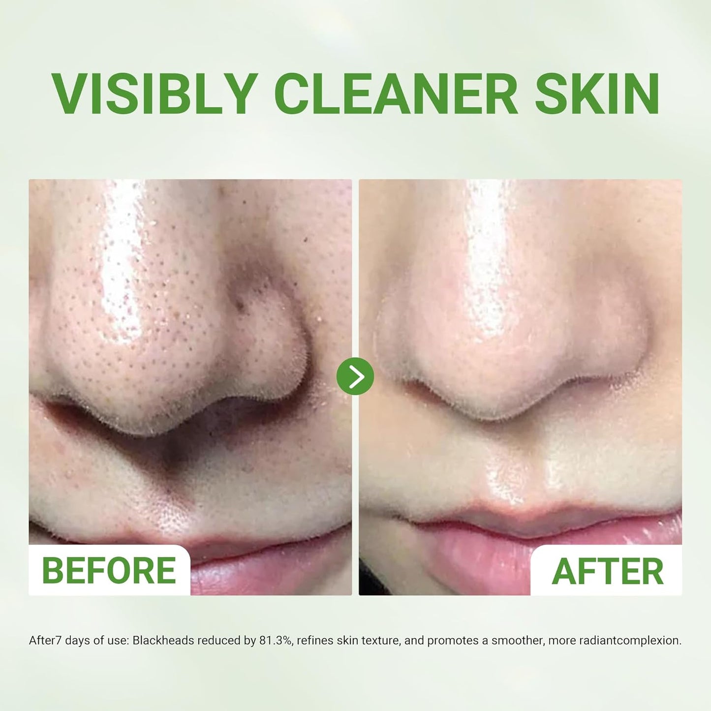 Skiennix 3X Acid Clay Mask - Deep Cleansing Facial Skincare for Pore Minimizing & Detox | 3.53 oz