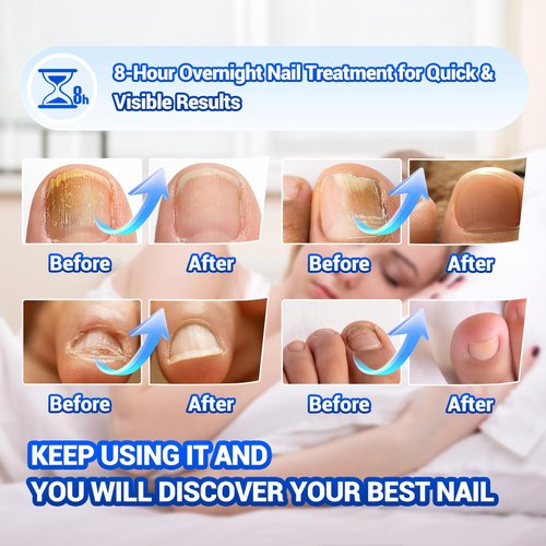 Regine Switzerland Toenail Fungus Treatment - 50 Extra Strength Hydrogel Nail Patches for Overnight Repair