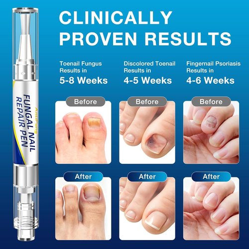 AntiFung Pen by Toenail Fungus Treatment - Extra Strength with 25% Undecylenic Acid - 3-Pack for Effective Nail Repair