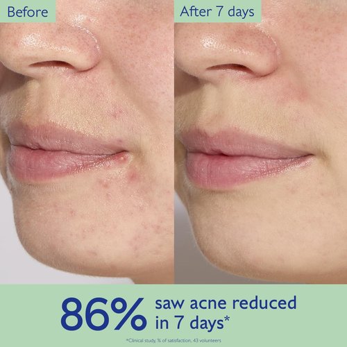 Caudalie Vinopure Acne Serum - Treat & Prevent Blemishes | Includes 2 Free Travel-Size Products