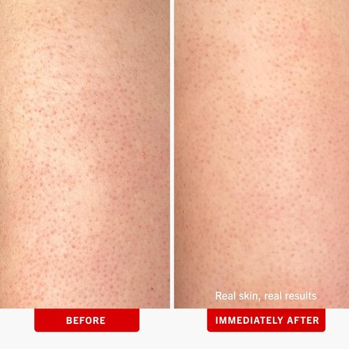 First Aid Beauty - KP Bump Eraser Body Scrub | 10% AHA Exfoliator for Keratosis Pilaris, 8 oz