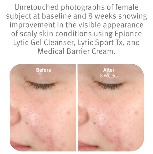 Epionce Lytic Gel Cleanser – Gentle Foaming Face Wash & Makeup Remover | For Oily, Combination & Problem Skin | Acne & Oil-Control Cleanser with Willow Bark | Dermatologist Skincare