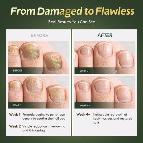 Regine Switzerland Toenail Fungus Treatment - Extra Strength with Undecylenic Acid & Tea Tree Oil | 30ml Antifungal Repair for Damaged Nails