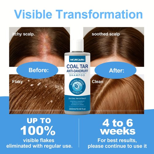 Morovan Coal Tar Dandruff Shampoo: 2% COAL TAR Extract for Severe Dandruff, Psoriasis & Itchy Scalp | Medicated Treatment for Seborrheic Dermatitis - Effective Flake and Itch Control.